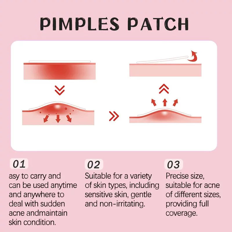 360 Pcs Acne Patches for Face, Hydrocolloid Pimple Cover Pimples and Spots, Spot Patch