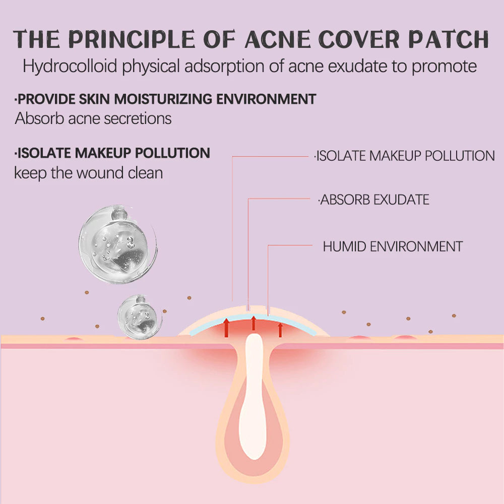 360 Pcs Acne Patches for Face, Hydrocolloid Pimple Cover Pimples and Spots, Spot Patch