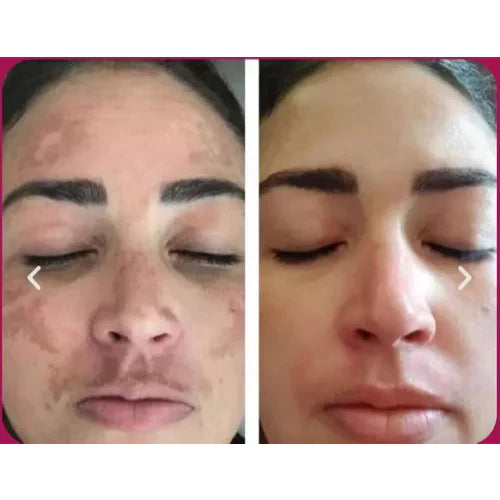 Amazonica Rosehip Serum — Remove Blemishes & Take Care of Your Skin
