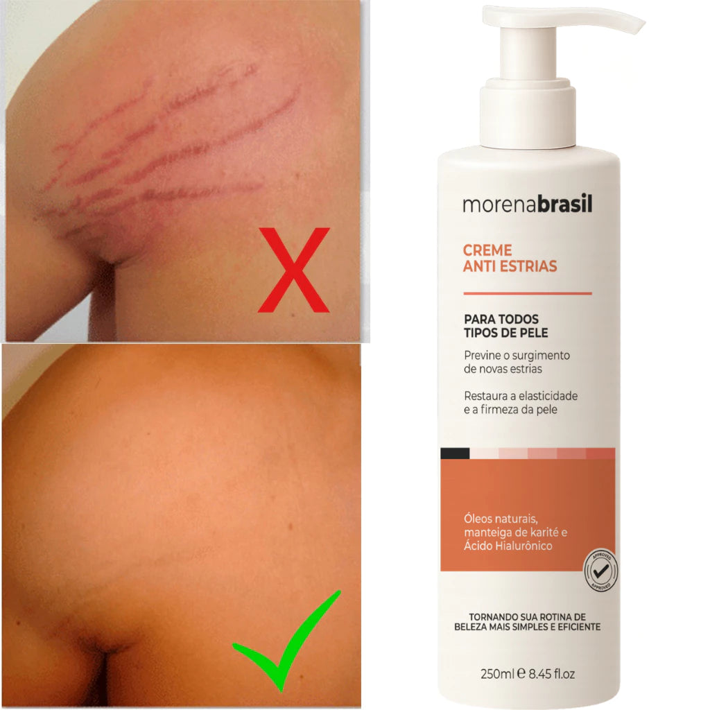 Anti-Stretch Mark Cream - Say Goodbye to Stretch Marks! Prevents New Stretch Marks & Strengthens Skin Elasticity