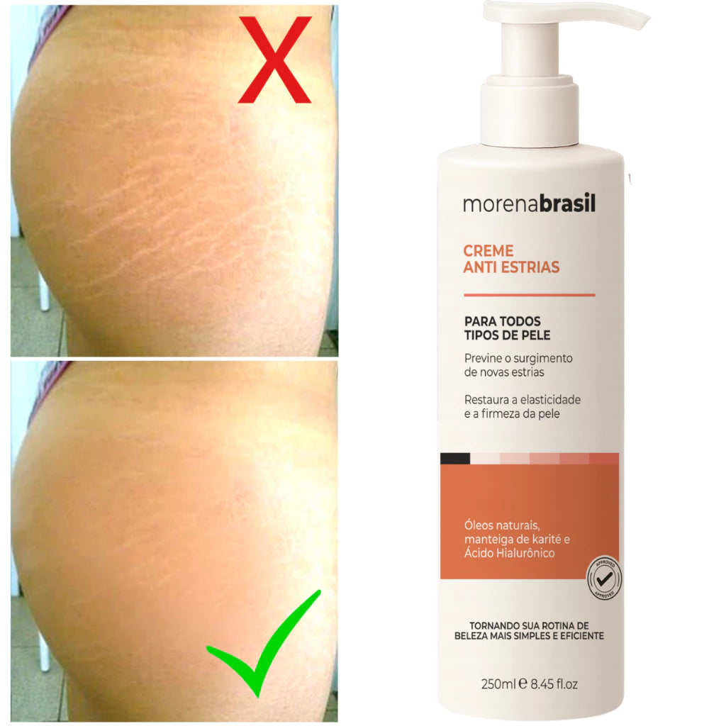 Anti-Stretch Mark Cream - Say Goodbye to Stretch Marks! Prevents New Stretch Marks & Strengthens Skin Elasticity