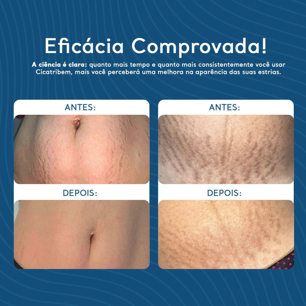 Anti-Stretch Mark Moisturizing Cream Dermal Regenerating 150g - Cicatribem - Stretch Mark Cream