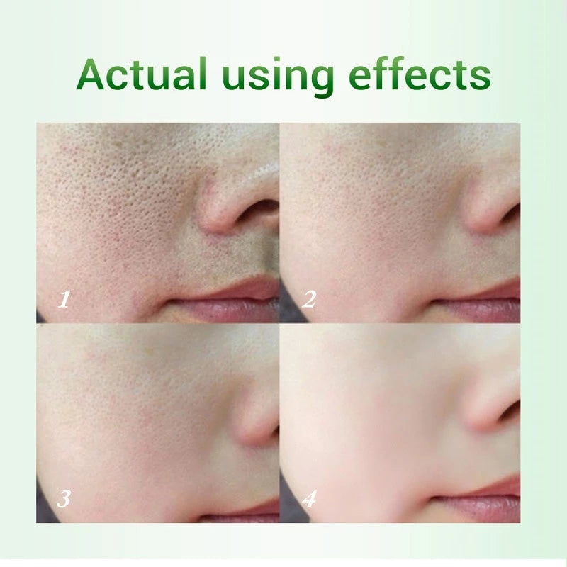 Creme Redutor de Poros com Ácido Salicílico 20g - Controle de Oleosidade e Antiacne