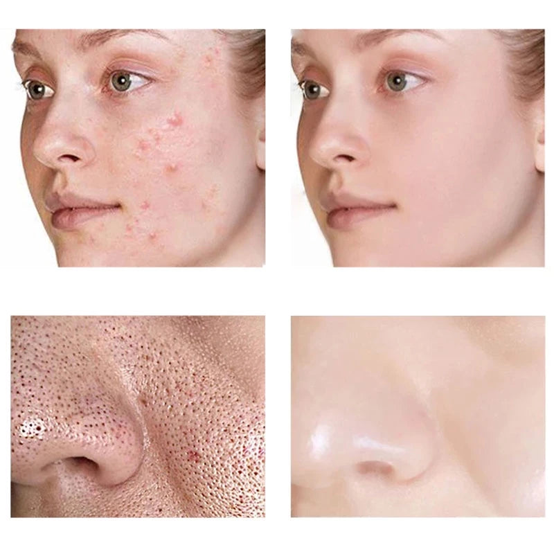 Creme Redutor de Poros com Ácido Salicílico 20g - Controle de Oleosidade e Antiacne